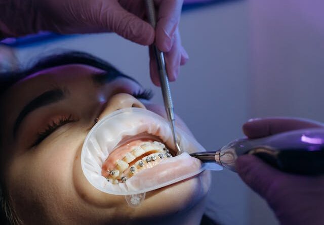 Jak wygląda zdejmowanie aparatu stałego metalowego?